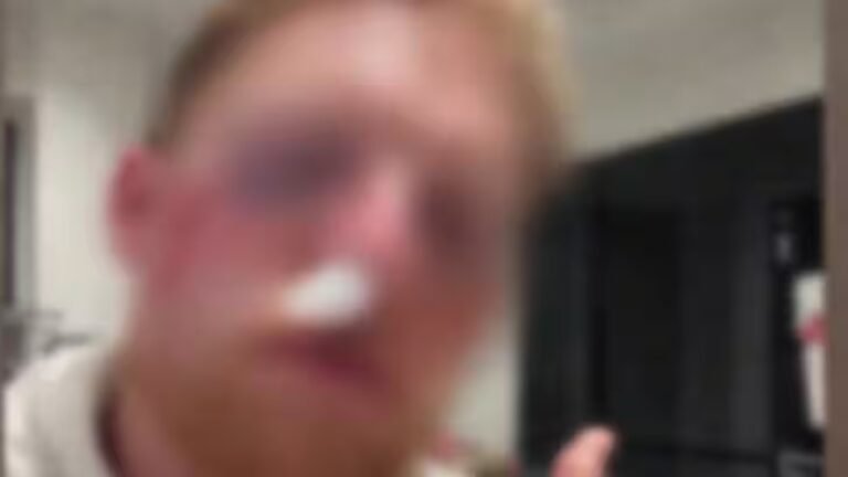 Star cricketer’s face DESTROYED by Cricket ball – Shocking photo will haunt you | Cricket News