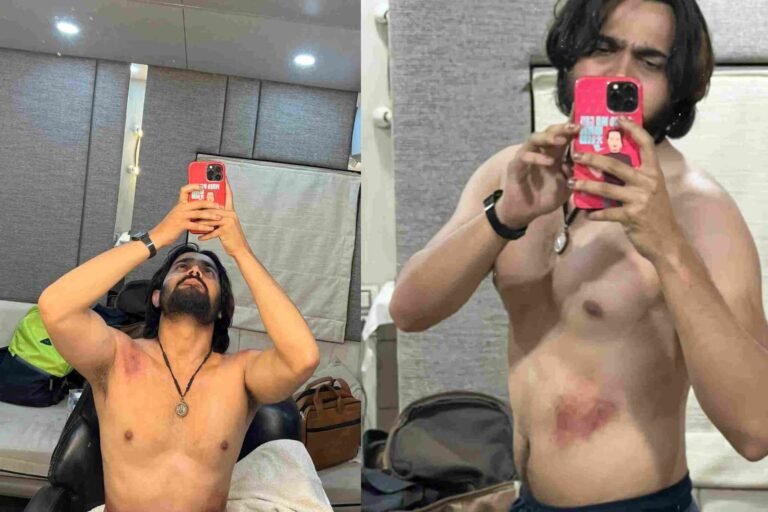 Bhuvan Bam sustains injury while shooting for Taaza Khabar
